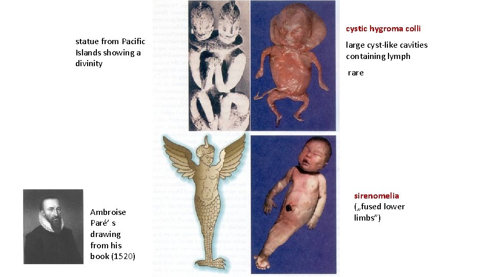 cystic hygroma colli statue from Pacific Islands showing a divinity Ambroise Paré’ s drawing