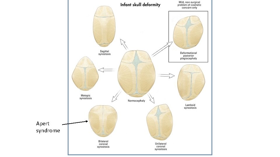 Apert syndrome 