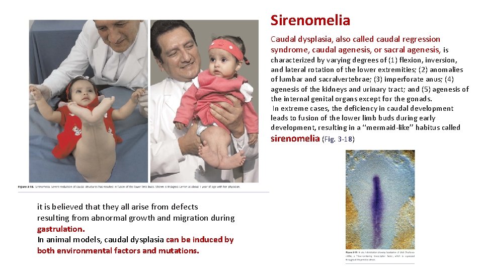 Sirenomelia Caudal dysplasia, also called caudal regression syndrome, caudal agenesis, or sacral agenesis, is