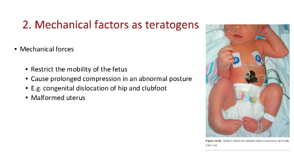 2. Mechanical factors as teratogens • Mechanical forces • • Restrict the mobility of