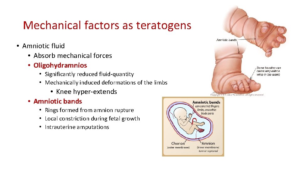 Mechanical factors as teratogens • Amniotic fluid • Absorb mechanical forces • Oligohydramnios •