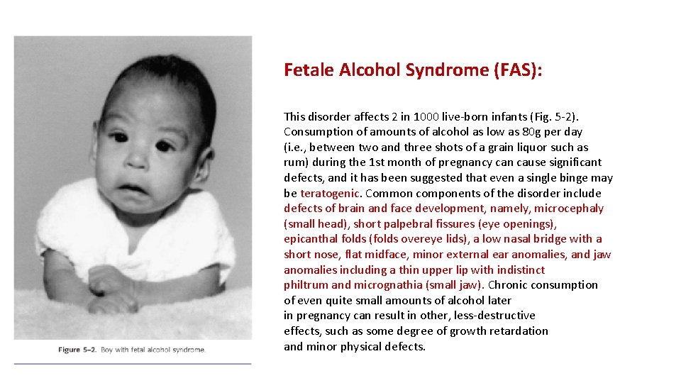 Fetale Alcohol Syndrome (FAS): This disorder affects 2 in 1000 live-born infants (Fig. 5