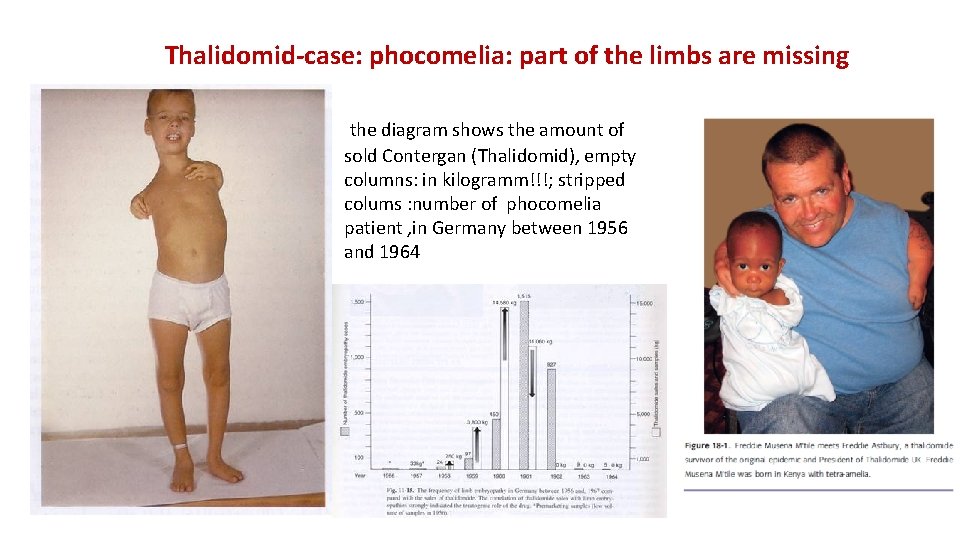 Thalidomid-case: phocomelia: part of the limbs are missing the diagram shows the amount of