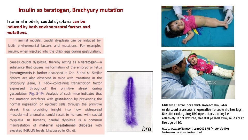 Insulin as teratogen, Brachyury mutation In animal models, caudal dysplasia can be induced by