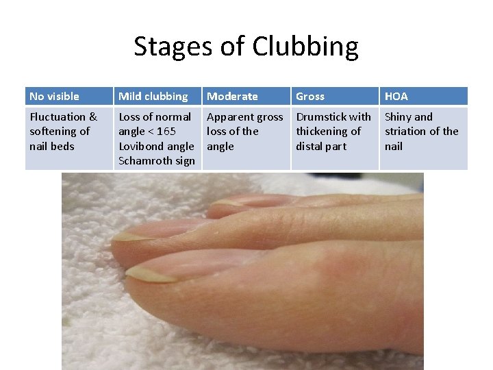Stages of Clubbing No visible Mild clubbing Moderate Gross HOA Fluctuation & softening of