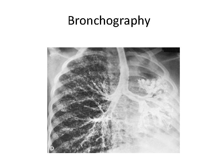 Bronchography 