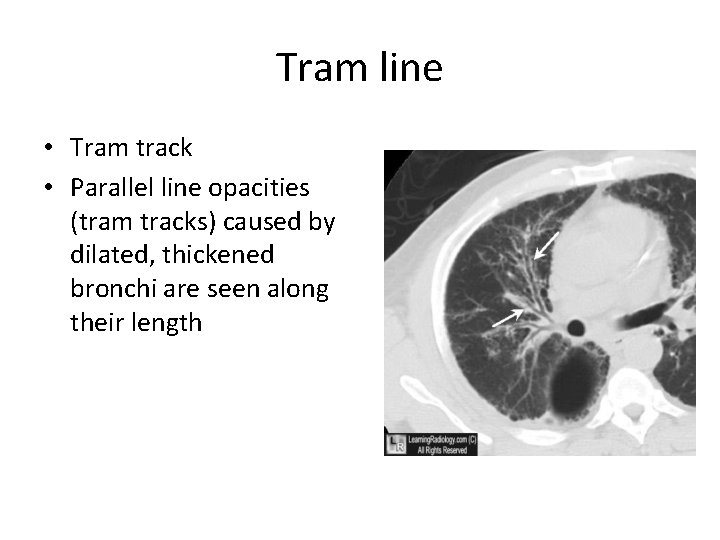 Tram line • Tram track • Parallel line opacities (tram tracks) caused by dilated,