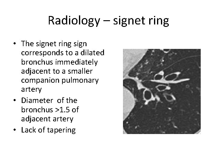 Radiology – signet ring • The signet ring sign corresponds to a dilated bronchus