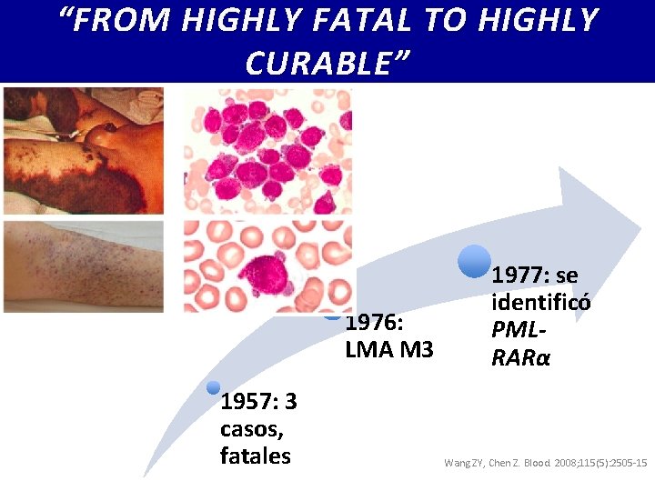 “FROM HIGHLY FATAL TO HIGHLY CURABLE” 1976: LMA M 3 1957: 3 casos, fatales