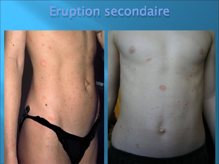 Eruption secondaire 