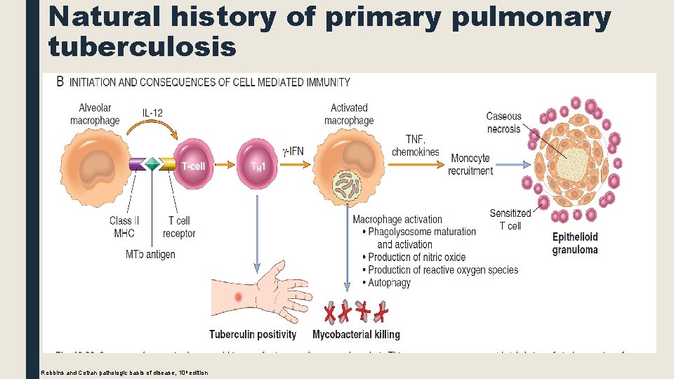 Natural history of primary pulmonary tuberculosis Robbins and Cotran pathologic basis of disease, 10