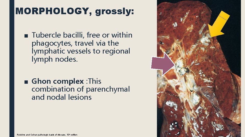 MORPHOLOGY, grossly: ■ Tubercle bacilli, free or within phagocytes, travel via the lymphatic vessels