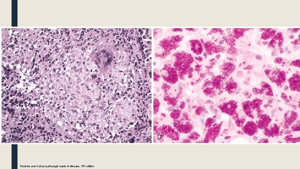 Robbins and Cotran pathologic basis of disease, 10 h edition 