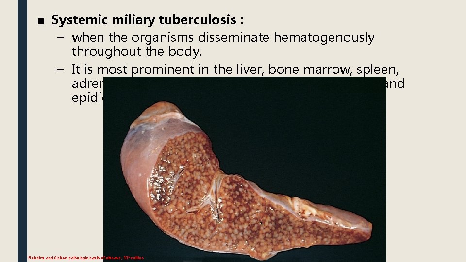 ■ Systemic miliary tuberculosis : – when the organisms disseminate hematogenously throughout the body.