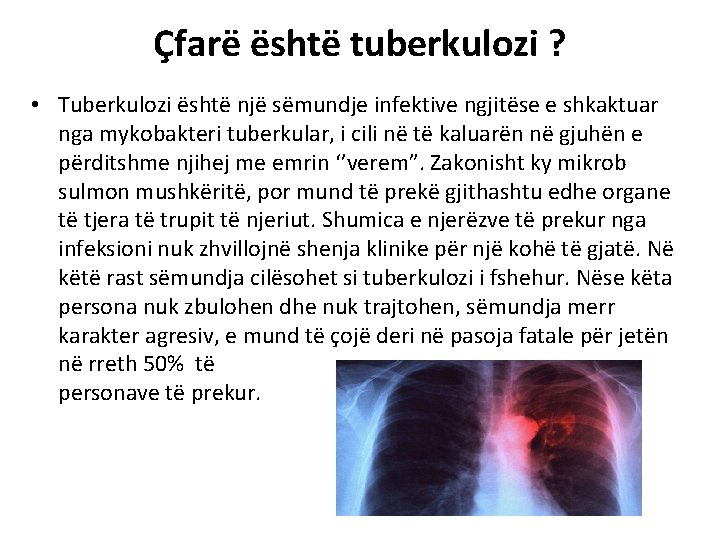 Çfarë është tuberkulozi ? • Tuberkulozi është një sëmundje infektive ngjitëse e shkaktuar nga
