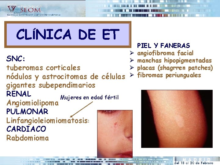 CLÍNICA DE ET Ø SNC: Ø Ø tuberomas corticales nódulos y astrocitomas de células