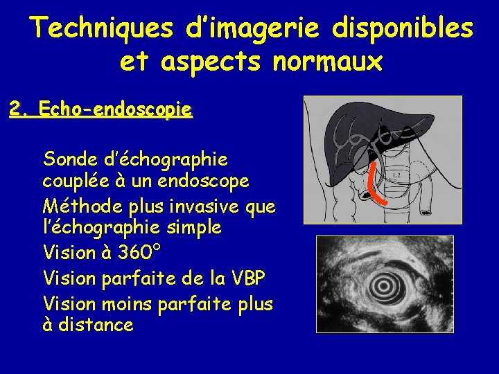 Techniques d’imagerie disponibles et aspects normaux 2. Echo-endoscopie Sonde d’échographie couplée à un endoscope