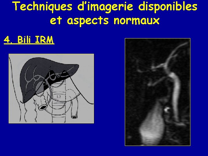 Techniques d’imagerie disponibles et aspects normaux 4. Bili IRM 