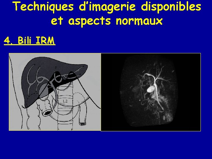 Techniques d’imagerie disponibles et aspects normaux 4. Bili IRM 