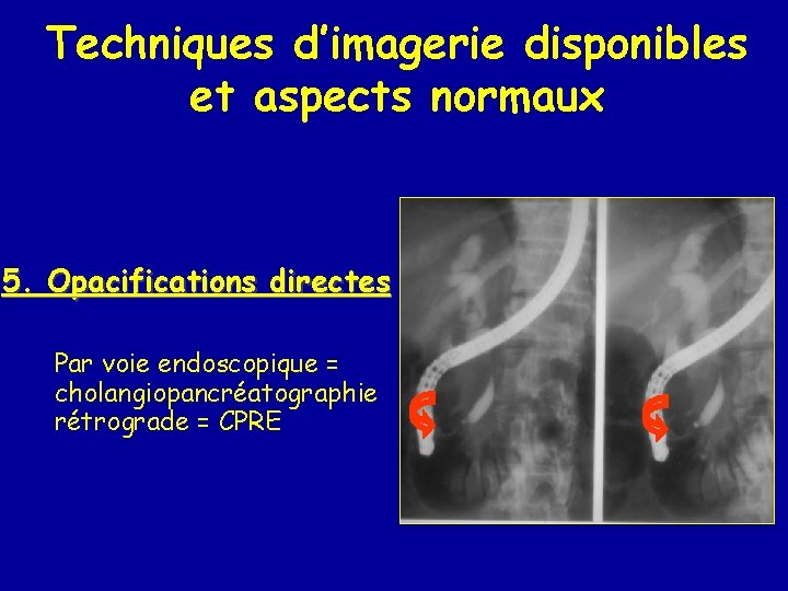 Techniques d’imagerie disponibles et aspects normaux 5. Opacifications directes Par voie endoscopique = cholangiopancréatographie