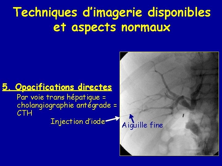 Techniques d’imagerie disponibles et aspects normaux 5. Opacifications directes Par voie trans hépatique =