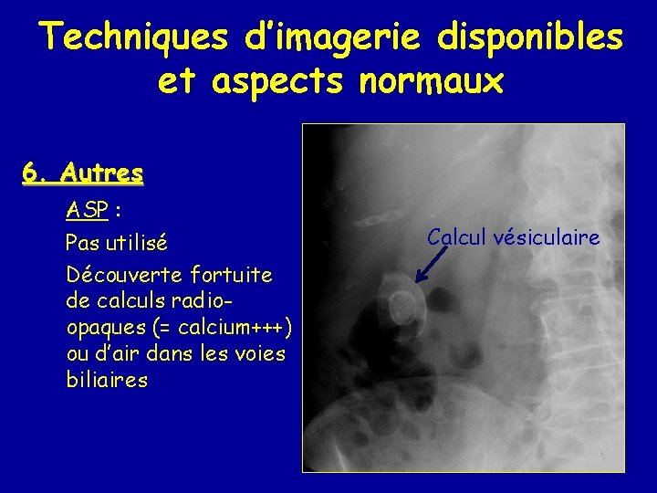 Techniques d’imagerie disponibles et aspects normaux 6. Autres ASP : Pas utilisé Découverte fortuite
