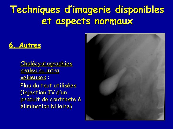 Techniques d’imagerie disponibles et aspects normaux 6. Autres Cholécystographies orales ou intra veineuses :