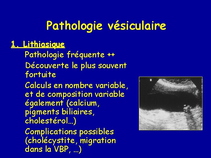 Pathologie vésiculaire 1. Lithiasique Pathologie fréquente ++ Découverte le plus souvent fortuite Calculs en