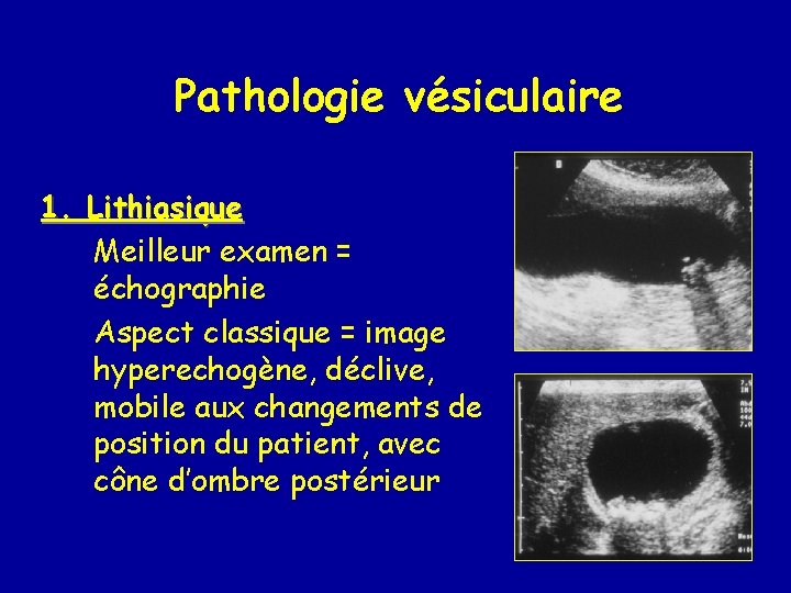 Pathologie vésiculaire 1. Lithiasique Meilleur examen = échographie Aspect classique = image hyperechogène, déclive,