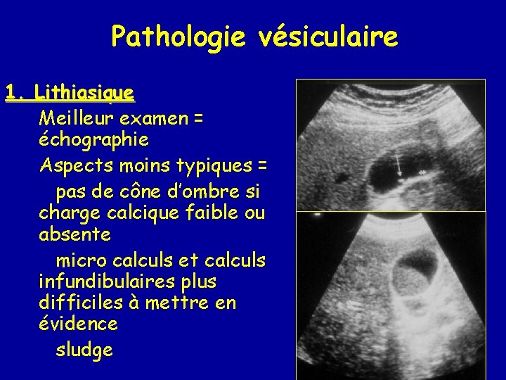 Pathologie vésiculaire 1. Lithiasique Meilleur examen = échographie Aspects moins typiques = pas de