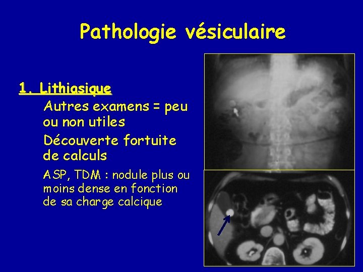 Pathologie vésiculaire 1. Lithiasique Autres examens = peu ou non utiles Découverte fortuite de
