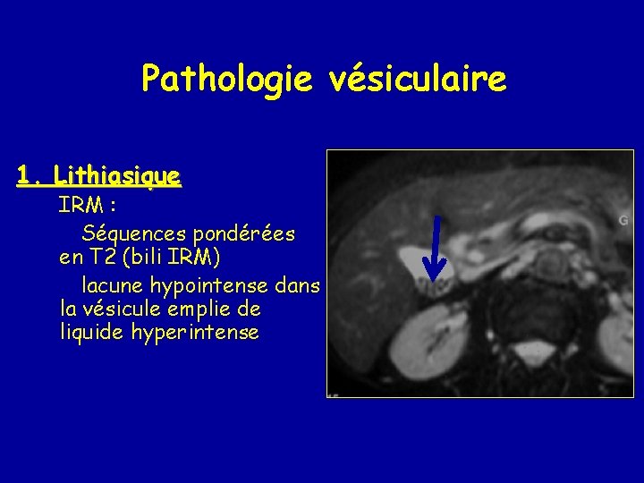 Pathologie vésiculaire 1. Lithiasique IRM : Séquences pondérées en T 2 (bili IRM) lacune