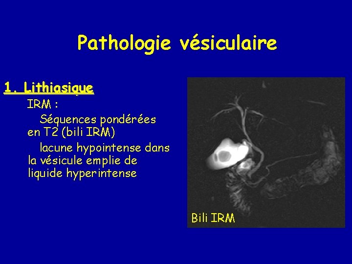 Pathologie vésiculaire 1. Lithiasique IRM : Séquences pondérées en T 2 (bili IRM) lacune