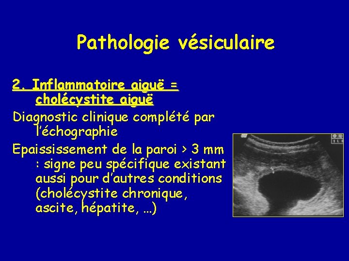 Pathologie vésiculaire 2. Inflammatoire aiguë = cholécystite aiguë Diagnostic clinique complété par l’échographie Epaississement