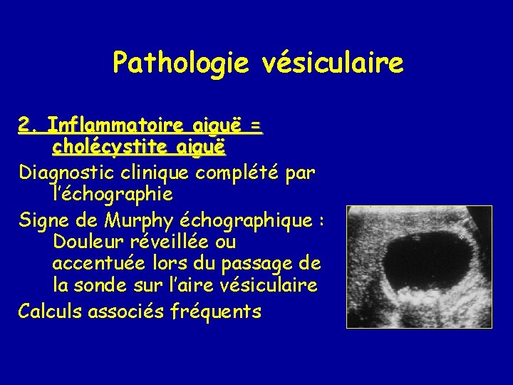 Pathologie vésiculaire 2. Inflammatoire aiguë = cholécystite aiguë Diagnostic clinique complété par l’échographie Signe