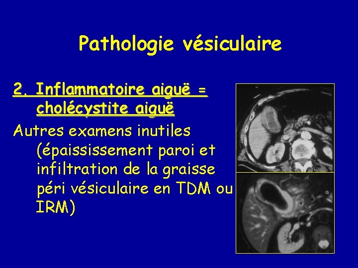 Pathologie vésiculaire 2. Inflammatoire aiguë = cholécystite aiguë Autres examens inutiles (épaississement paroi et