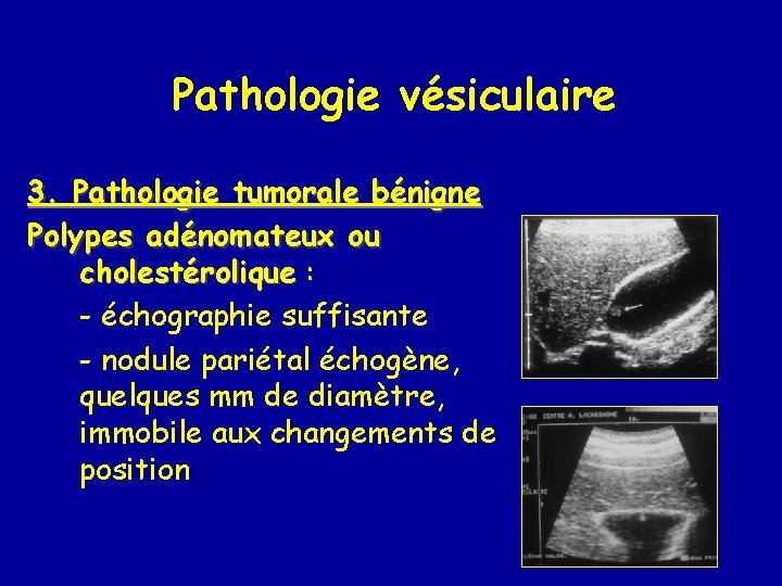 Pathologie vésiculaire 3. Pathologie tumorale bénigne Polypes adénomateux ou cholestérolique : - échographie suffisante