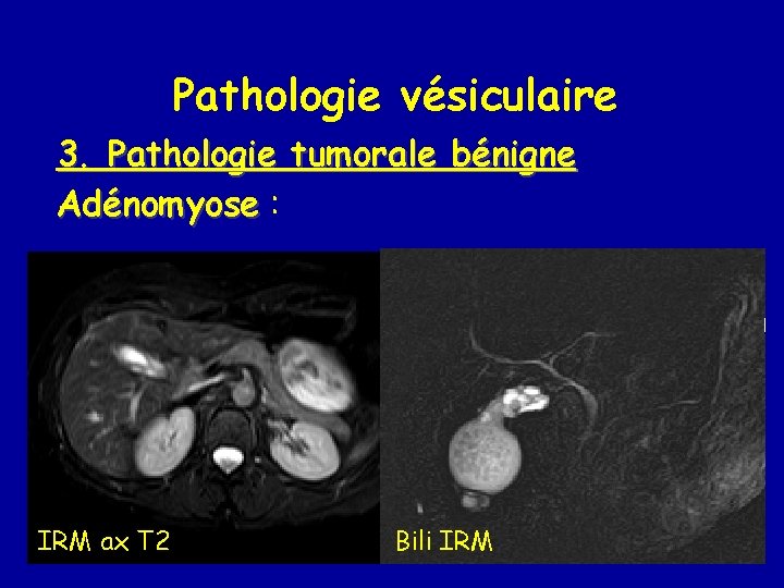 Pathologie vésiculaire 3. Pathologie tumorale bénigne Adénomyose : IRM ax T 2 Bili IRM