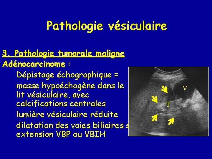Pathologie vésiculaire 3. Pathologie tumorale maligne Adénocarcinome : Dépistage échographique = masse hypoéchogène dans
