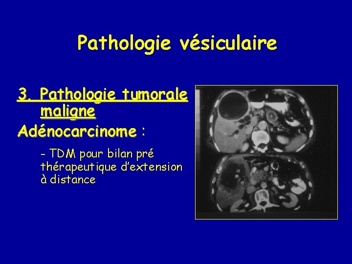 Pathologie vésiculaire 3. Pathologie tumorale maligne Adénocarcinome : - TDM pour bilan pré thérapeutique