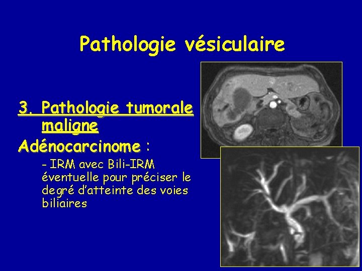 Pathologie vésiculaire 3. Pathologie tumorale maligne Adénocarcinome : - IRM avec Bili-IRM éventuelle pour
