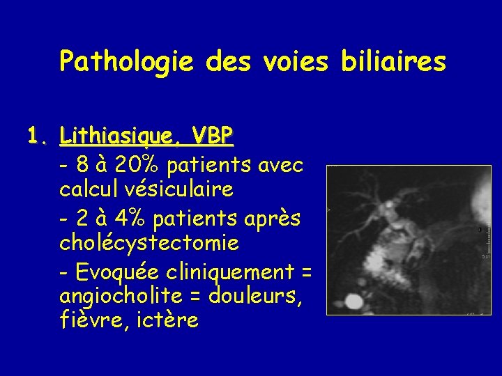 Pathologie des voies biliaires 1. Lithiasique, VBP - 8 à 20% patients avec calcul