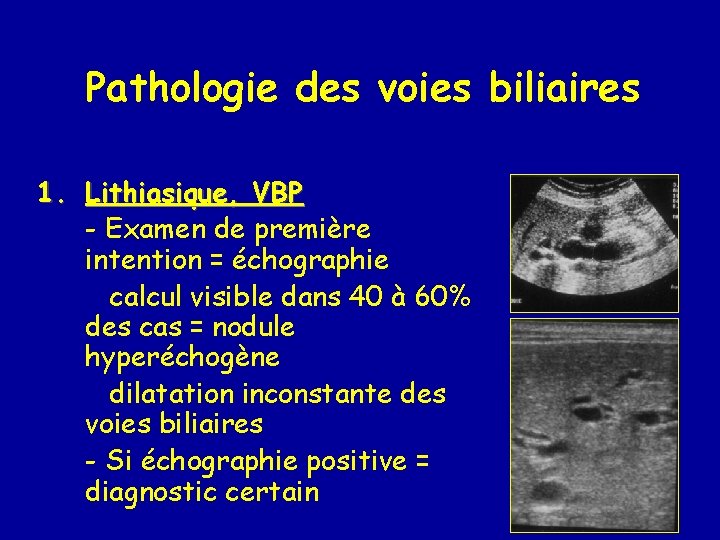 Pathologie des voies biliaires 1. Lithiasique, VBP - Examen de première intention = échographie