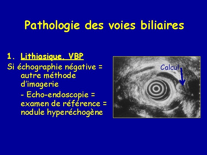 Pathologie des voies biliaires 1. Lithiasique, VBP Si échographie négative = autre méthode d’imagerie