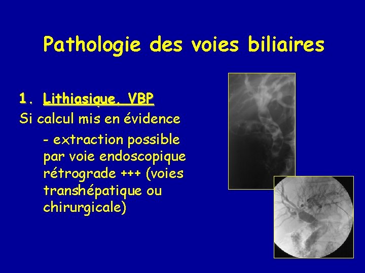 Pathologie des voies biliaires 1. Lithiasique, VBP Si calcul mis en évidence - extraction
