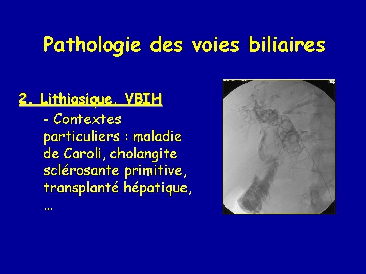 Pathologie des voies biliaires 2. Lithiasique, VBIH - Contextes particuliers : maladie de Caroli,