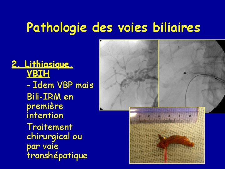 Pathologie des voies biliaires 2. Lithiasique, VBIH - Idem VBP mais Bili-IRM en première
