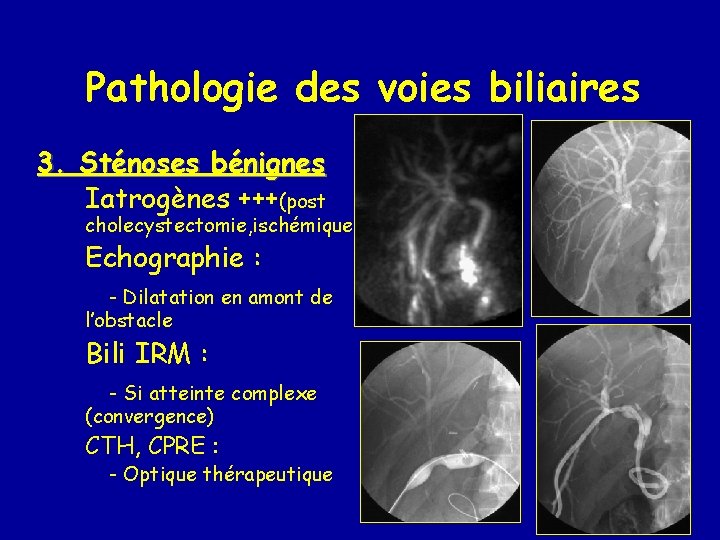 Pathologie des voies biliaires 3. Sténoses bénignes Iatrogènes +++(post cholecystectomie, ischémiques…) Echographie : -