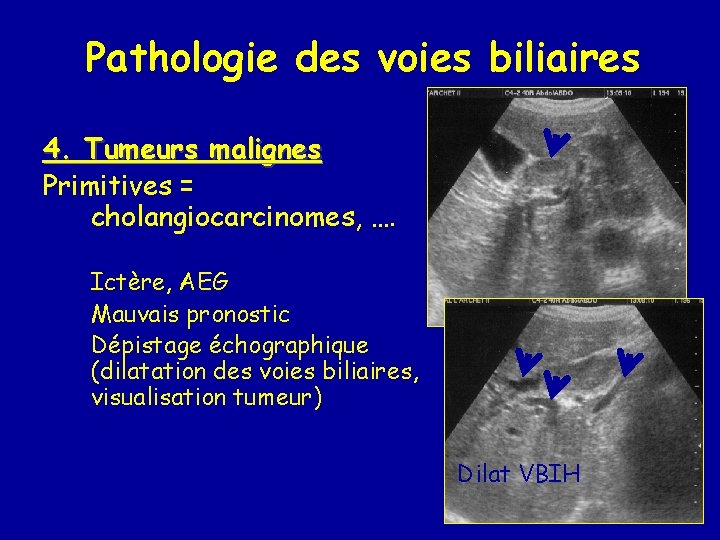 Pathologie des voies biliaires 4. Tumeurs malignes Primitives = cholangiocarcinomes, …. Ictère, AEG Mauvais
