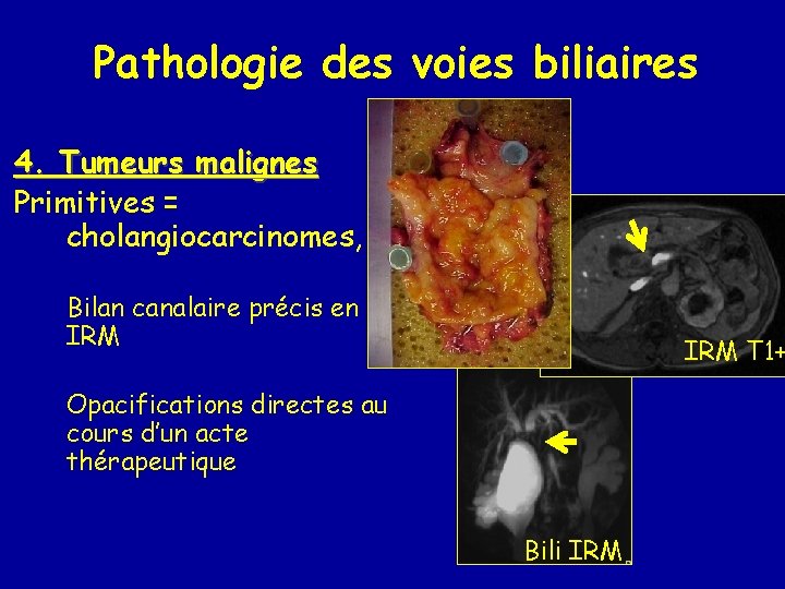 Pathologie des voies biliaires 4. Tumeurs malignes Primitives = cholangiocarcinomes, …. Bilan canalaire précis